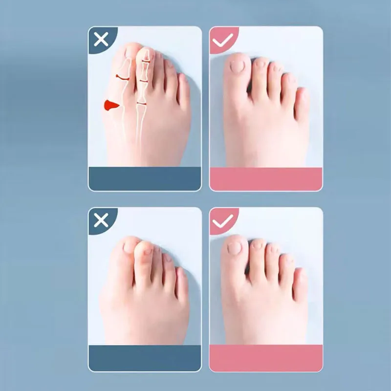 2Pc Silicone Toe Separator Fingers Feet Toe Spreader Hallux Valgus Bunion Corrector Toe Straightener Corrector Finger Separators - Image 3