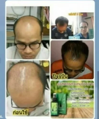 120ml Ne Hair Lotion Hair Root HAIR BEARD SIDEBURNS LONGER Herbs Treatment 100% Original Thailand Free Gift - Image 2